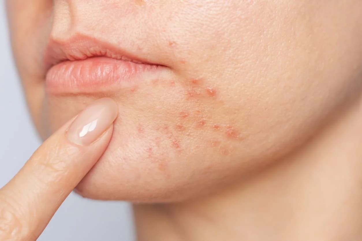 Battling Humidity-Induced Acne and Clogged Pores in Singapore